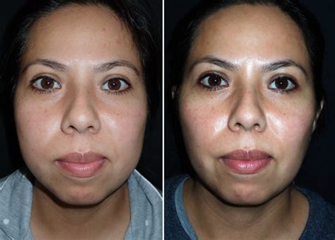 Buccal fat pad removal to improve facial aesthetics: an .